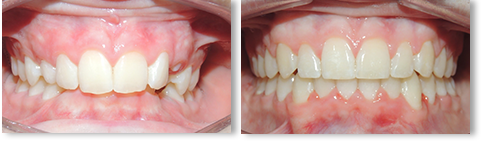 before-after-01