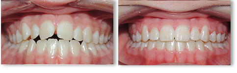 before-after-02